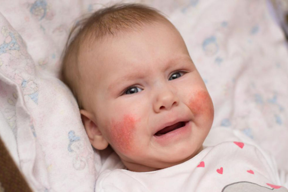 PRVO EKCEM A ONDA ALERGIJA: Deca sa atopijskim dermatitisom češće su pozitivna na alergije