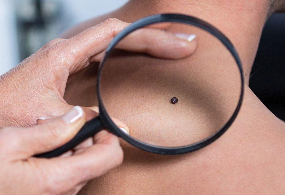  Od melanoma se svake godine razboli oko 700 osoba u Srbiji.