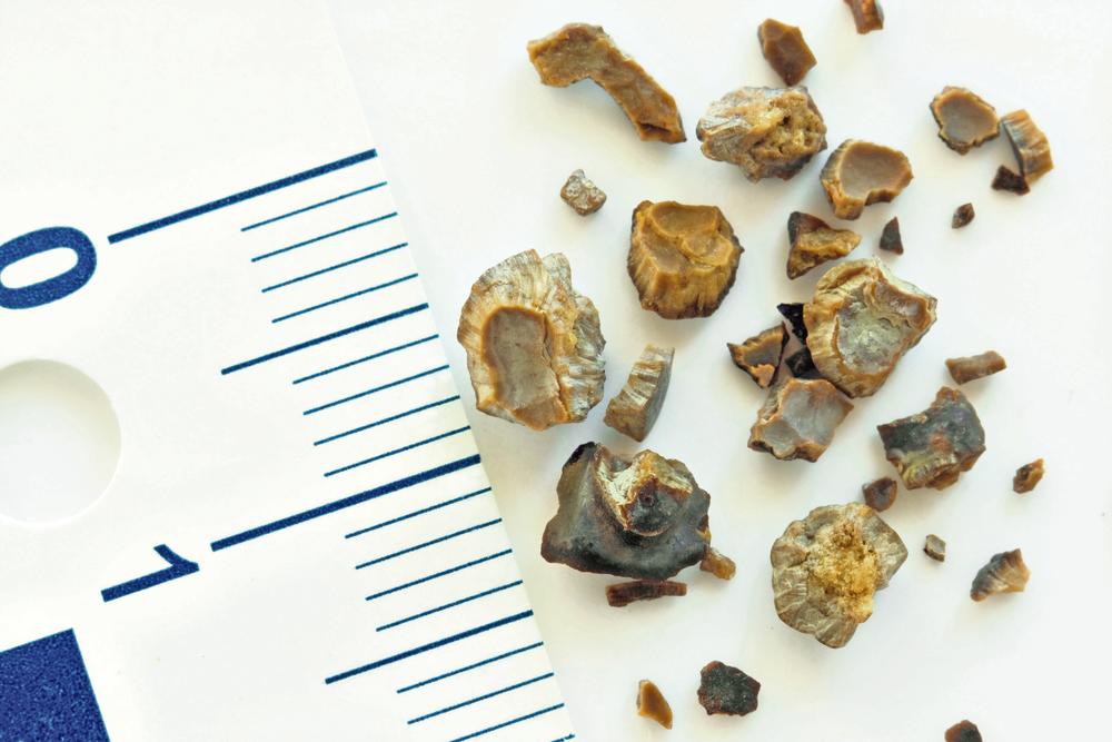 Kamen u bubregu može biti veličine od zrna peska do loptice za gol