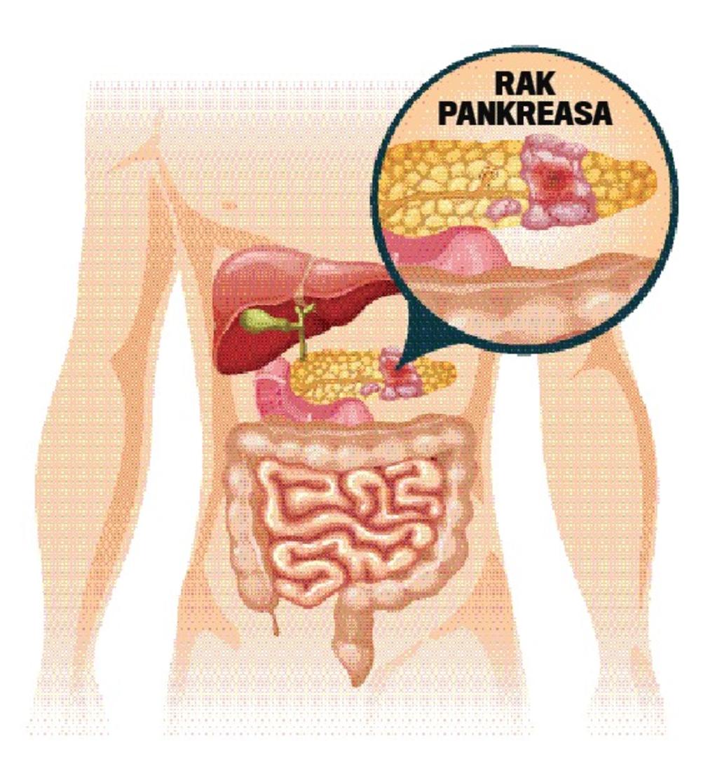 Rak Pankreasa