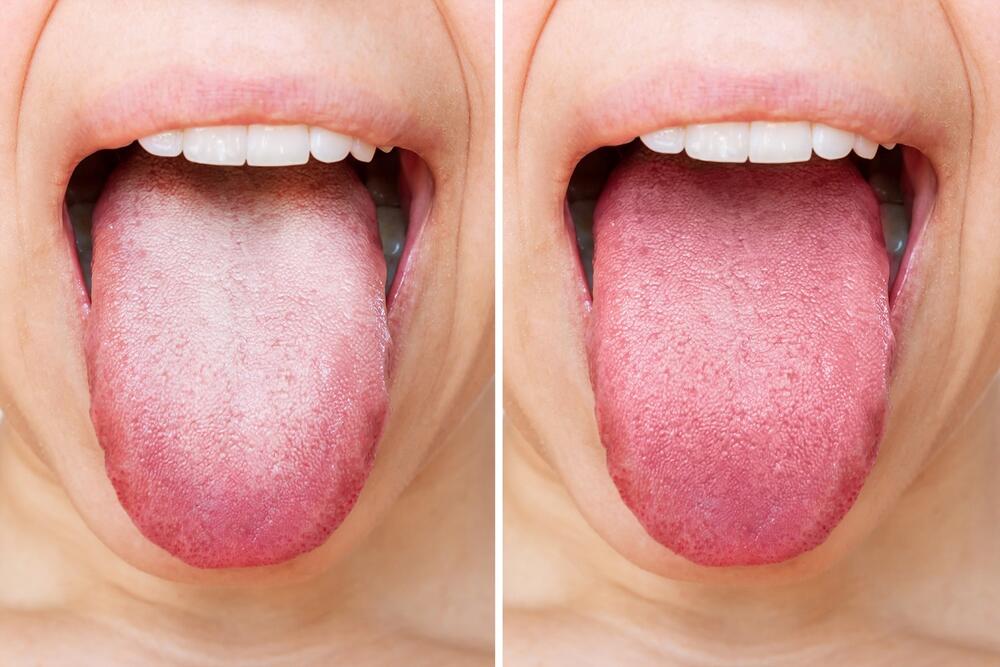 beo jezik je najčešće povezan sa nepravilnom higijenom