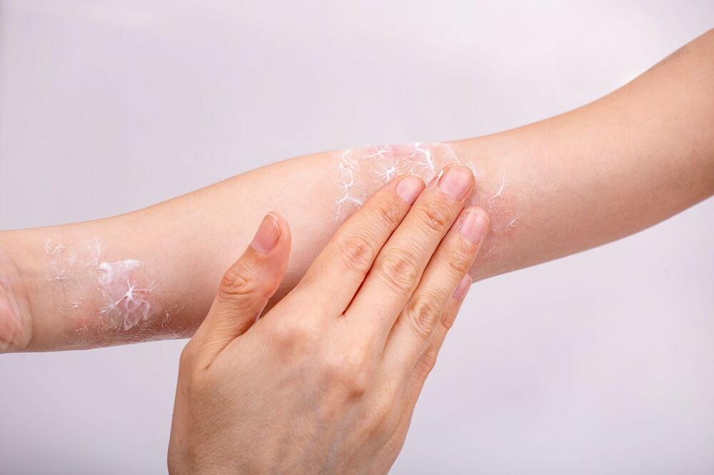 Ljudi sa ekcemom treba uvek da testiraju nove proizvode za negu kože