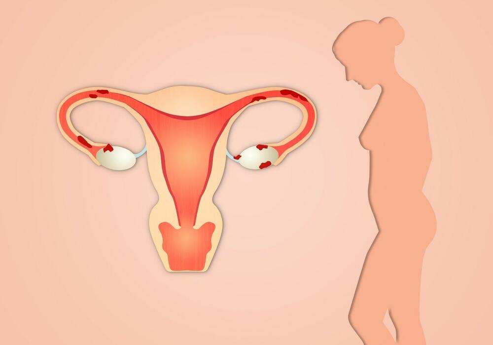 Endometrioza je bolest u kojoj tkivo slično sluzokoži materice raste izvan nje
