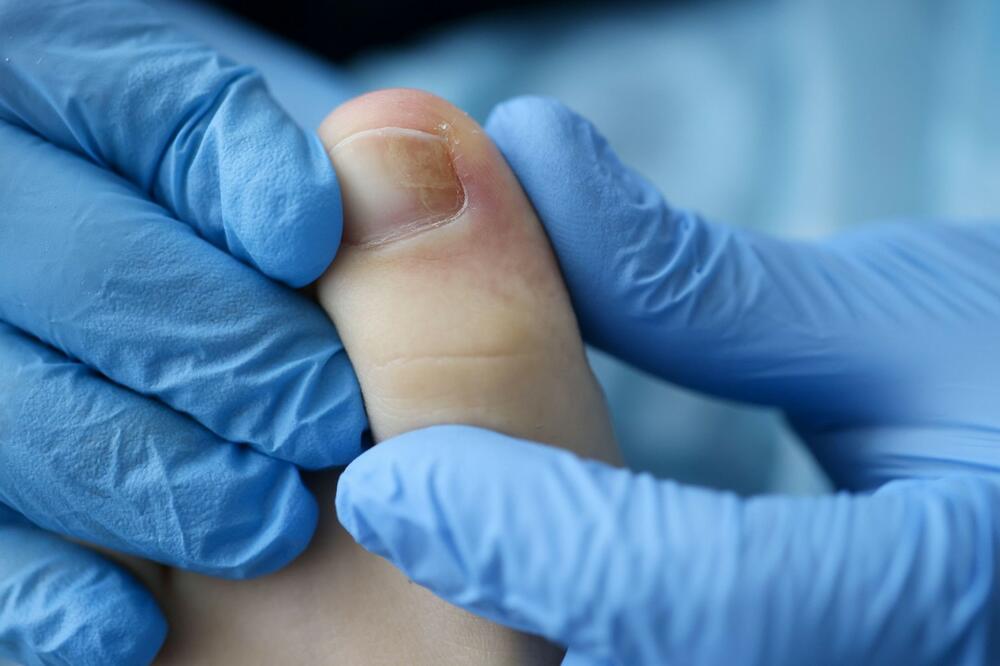 Ako se problem javlja više puta na istom nožnom prstu, lekar vam može predložiti uklanjanje dela nokta