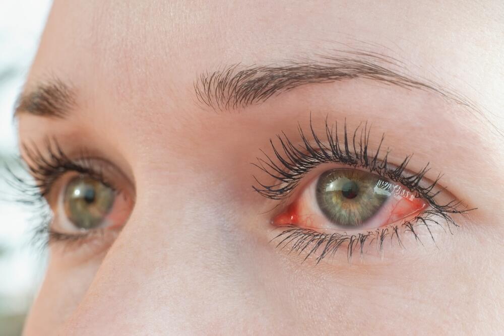 Crvenilo oka može biti znak drugog problema