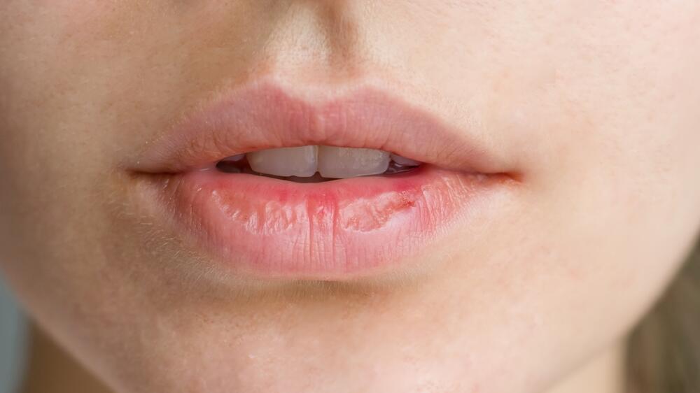 Suvoća vaših usana može značiti nedostatak vlage i hidratacije u ostatku vašeg tela