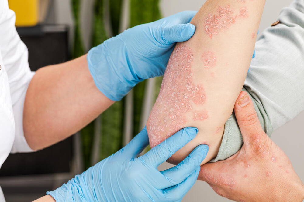 Biološka terapija pomaže u smanjenju ili nestanku promena na koži pacijenta
