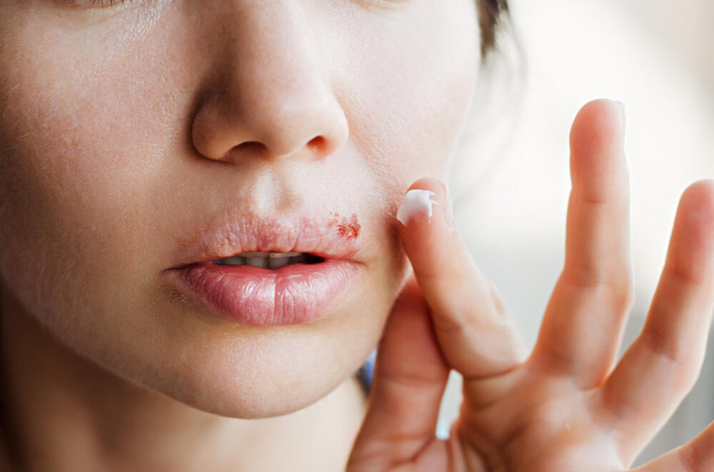 Virus koji stoji iza uobičajenih plikova i groznica na obodima usta mogao bi da bude odgovoran za povećan rizik od oboljevanja nekih bolesti.