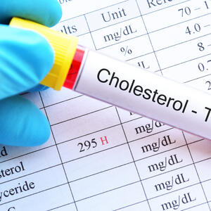 Sve što treba da znate o holesterolu: Za loše rezultate krvi nije kriva