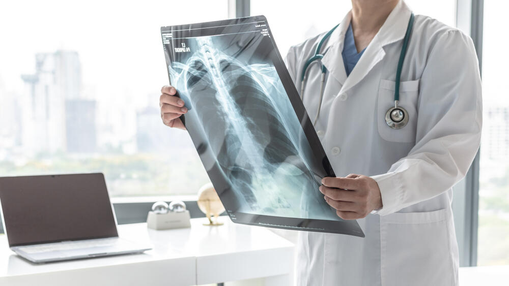 rendgenski snimak pluća, tuberkuloza, rendgenski snimak