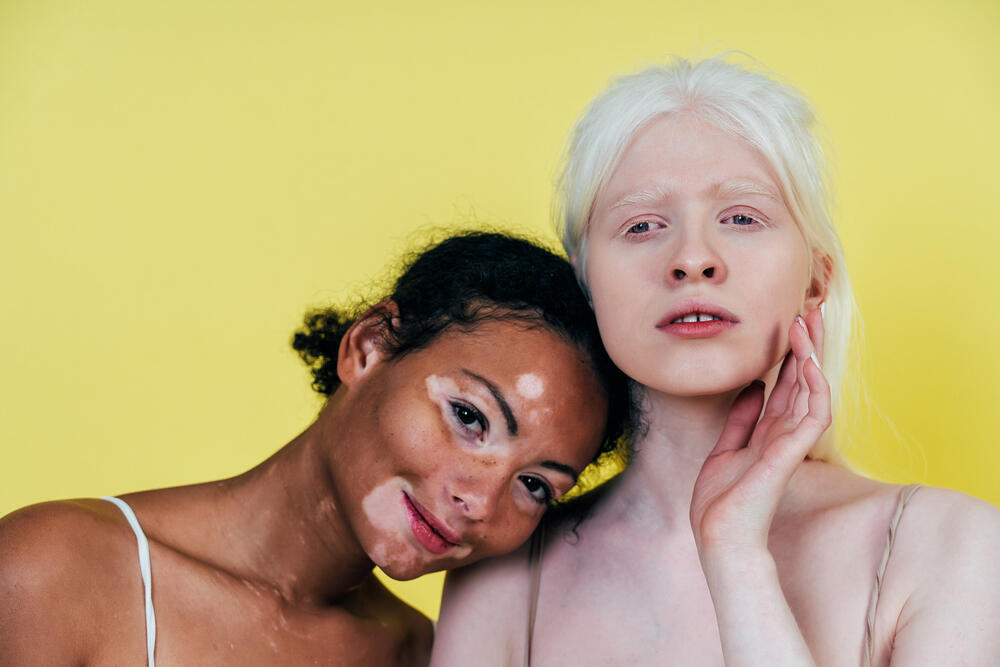 virtiligo i albino osobe, delimični i potpuni nedostatak pigmenta