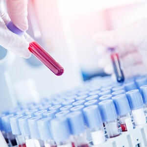 Test krvi može predvideti rizik od apneje: Ovaj problem uvećava rizik od