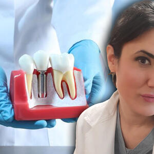 Stomatolog otkriva sve o zubnim implantima: Od jednog zuba do nadoknade