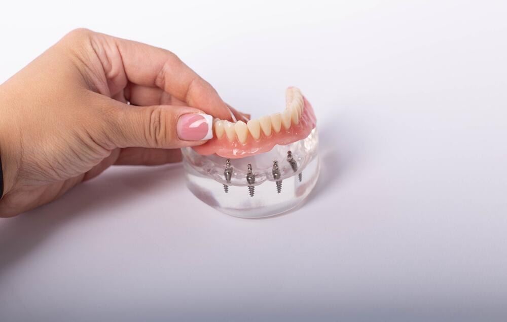 Kod potpune bezubosti zubni impanti mogu biti nosači proteza ili fiksnih radova koji nadoknađuju cele vilice.