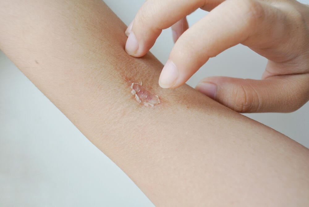 impetigo, infekcija kože, bakterijska infekcija